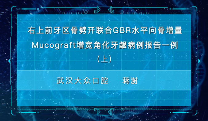右上前牙区骨劈开联合GBR水平向骨增量Mucograft增宽角化牙龈病例报告一例（上）