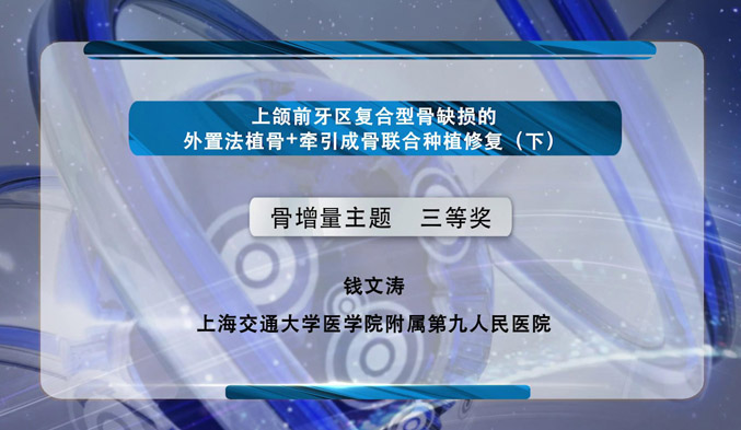 上颌前牙区复合型骨缺损的外置法植骨+牵引成骨联合种植修复（下）