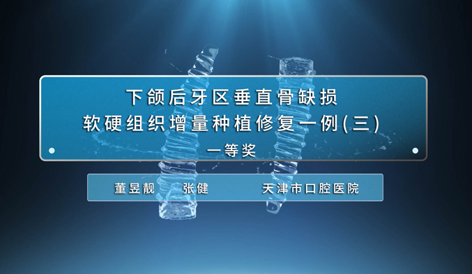 下颌后牙区垂直骨缺损软硬组织增量种植修复一例（三）
