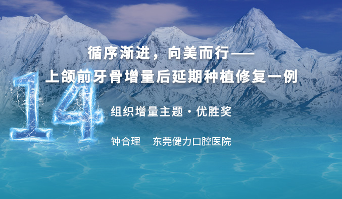 循序渐进，向美而行——上颌前牙骨增量后延期种植修复一例