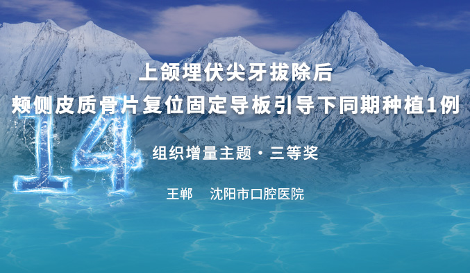 上颌埋伏尖牙拔除后颊侧皮质骨片复位固定导板引导下同期种植1例