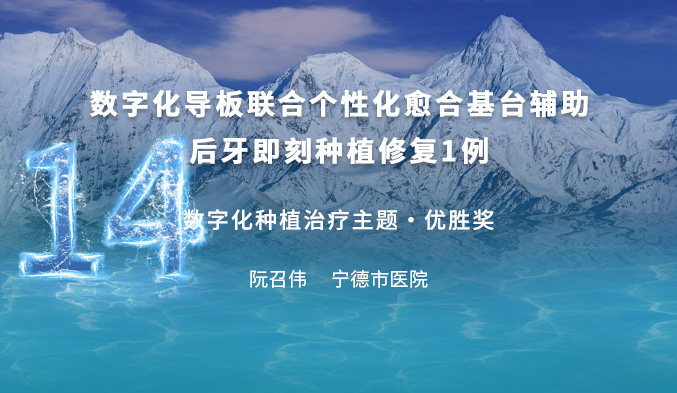 数字化导板联合个性化愈合基台辅助后牙即刻种植修复一例