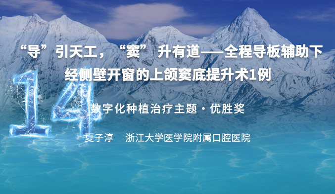 “导”引天工，“窦” 升有道——全程导板辅助下经侧壁开窗的上颌窦底提升术一例