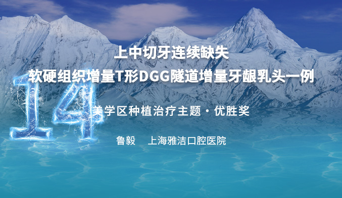 上中切牙连续缺失软硬组织增量  T形DGG隧道增量牙龈乳头一例