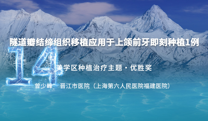 隧道瓣结缔组织移植应用于上颌前牙即刻种植一例