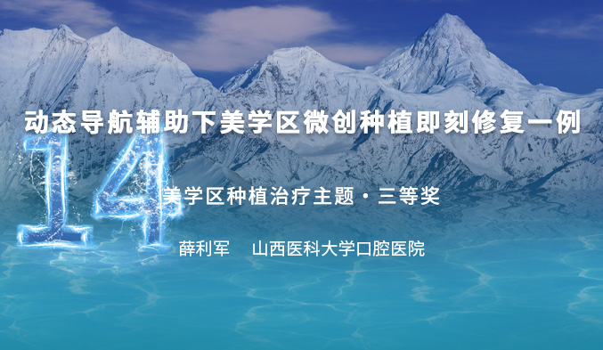 动态导航辅助下美学区微创种植即刻修复一例