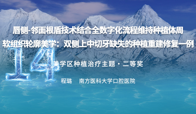 唇侧-邻面根盾技术结合全数字化流程维持种植体周软组织轮廓美学：双侧上中切牙缺失的种植重建修复一例
