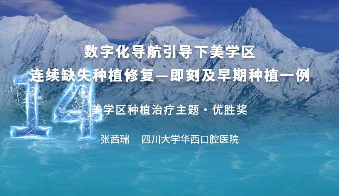 数字化导航引导下美学区连续缺失种植修复—即刻及早期种植一例
