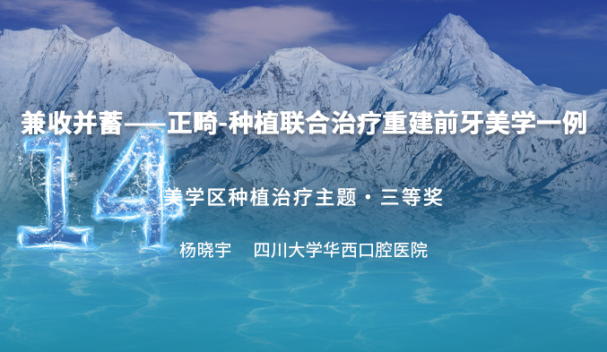 兼收并蓄——正畸-种植联合治疗重建前牙美学一例