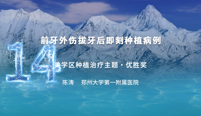 就地取材 殊途同归——前牙外伤拔牙后即刻种植病例