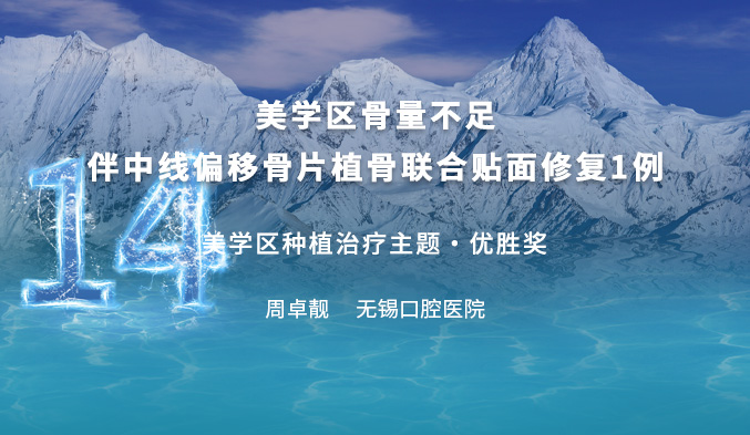 美学区骨量不足伴中线偏移骨片植骨联合贴面修复1例