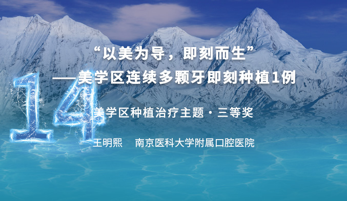 “以美为导，即刻而生”——美学区连续多颗牙即刻种植一例