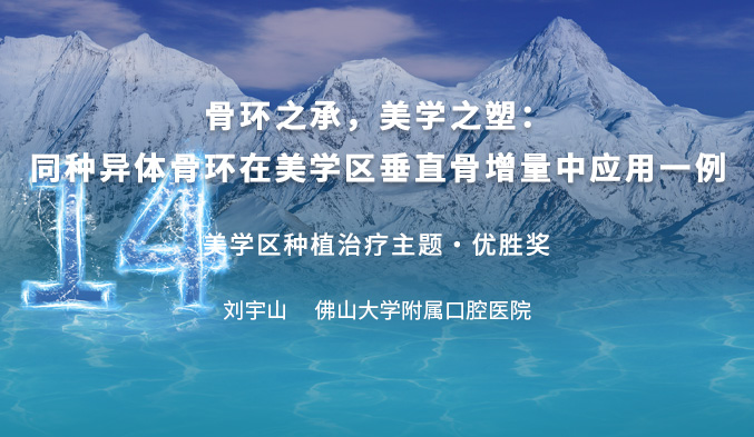 骨环之承，美学之塑：同种异体骨环在美学区垂直骨增量中应用一例