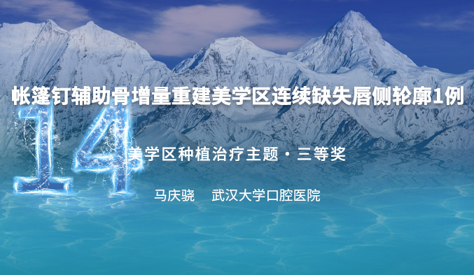 删繁就简，重建笑颜——美学区连续缺失行帐篷钉辅助骨增量重建唇侧轮廓一例
