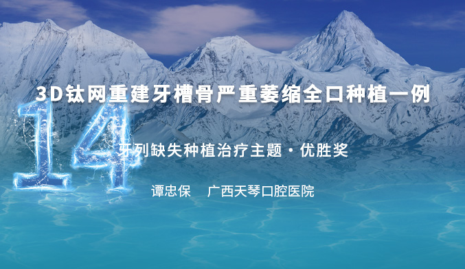 3D钛网重建牙槽骨严重萎缩全口种植一例
