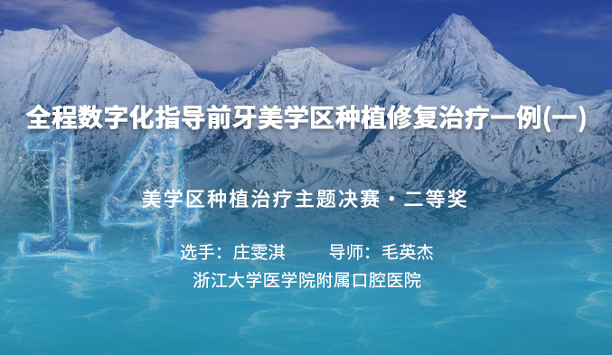 全程数字化指导前牙美学区种植修复治疗一例（一）